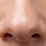 What Is a Pore Tightening Treatment