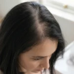 Understanding the early signs of thinning hair to explore various non-invasive treatments for thinning hair