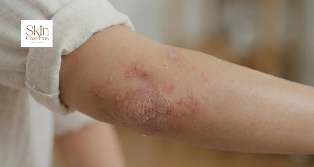 Close up of an arm showing dry itchy and cracked patches in the elbow fold characteristic of eczema