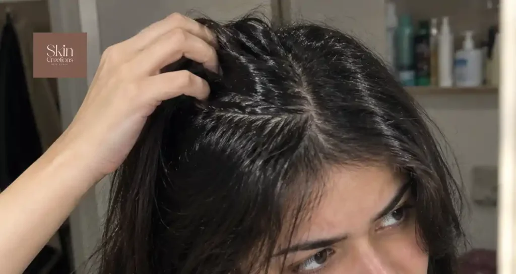 Greasy scalp symptoms